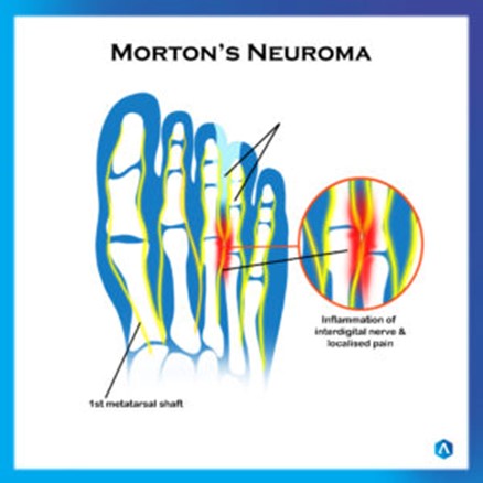 Morton’s Neuroma – Crown Medical Orthotics