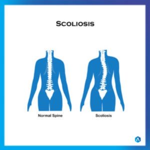 Scoliosis – Crown Medical Orthotics